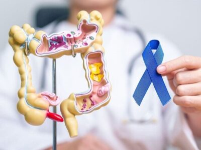 نقش ژنتیک در سرطان روده بزرگ؛ از پیشگیری تا تشخیص زودهنگام
